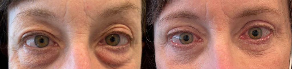 Cosmetic Upper Eyelid Blepharoplasty Patient 08