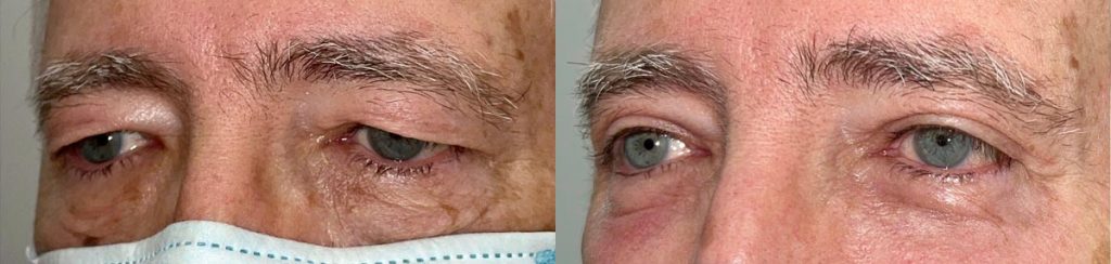 Cosmetic Lower Eyelid Blepharoplasty Patient 12