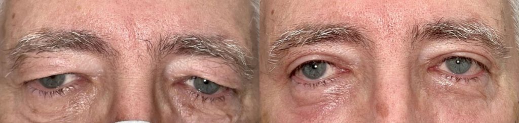 Cosmetic Upper Eyelid Blepharoplasty Patient 09