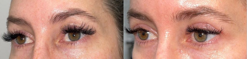 Cosmetic Upper Eyelid Blepharoplasty Patient 10