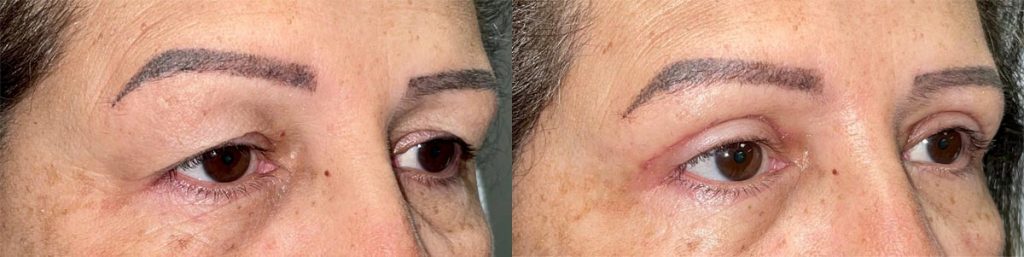 Cosmetic Upper Eyelid Blepharoplasty Patient 01