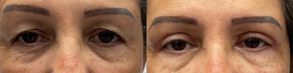 Cosmetic Upper Eyelid Blepharoplasty Patient 01