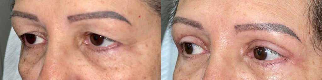 Cosmetic Upper Eyelid Blepharoplasty Patient 01