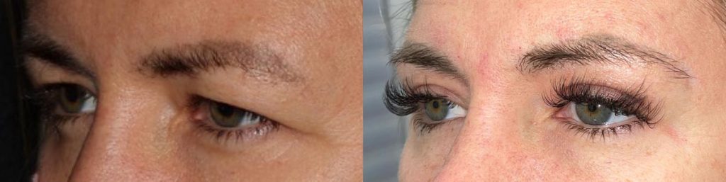 Cosmetic Upper Eyelid Blepharoplasty Patient 02