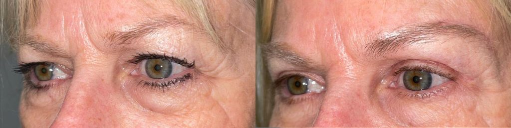 Cosmetic Brow Lift Patient 02