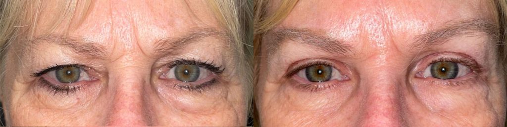 Cosmetic Brow Lift Patient 02